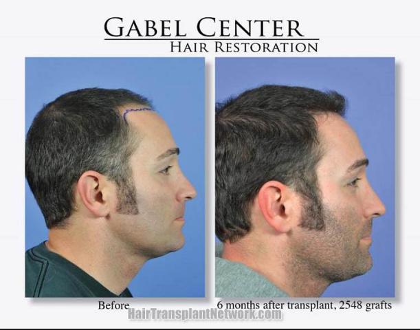 Before and after hair transplant procedure images