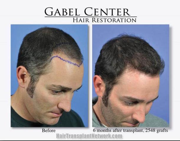 Hair restoration surgery before and after photos