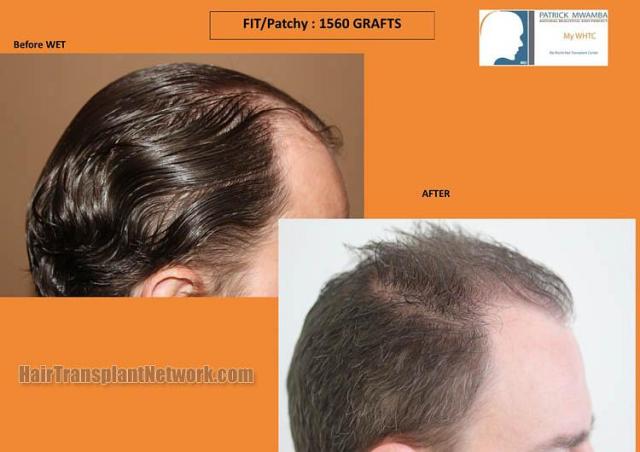 Hair transplantation surgery before and after images