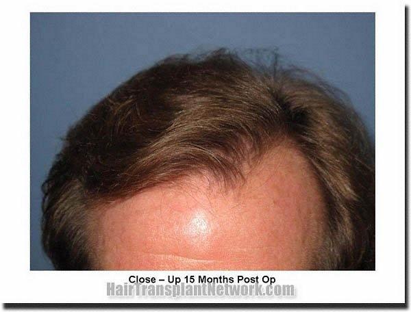 Hair restoration procedure results