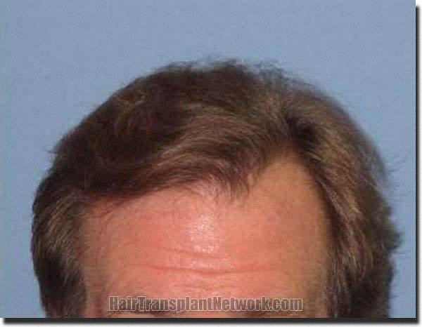 Hair restoration procedure results