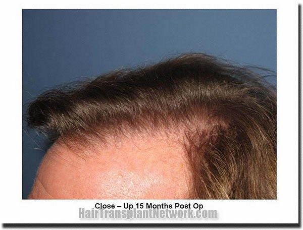 Hair restoration procedure results