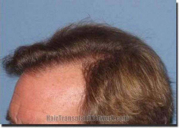 Hair restoration procedure results