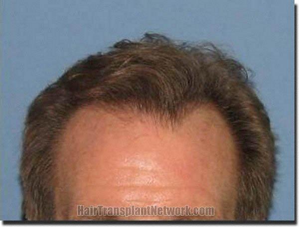 Hair restoration procedure results