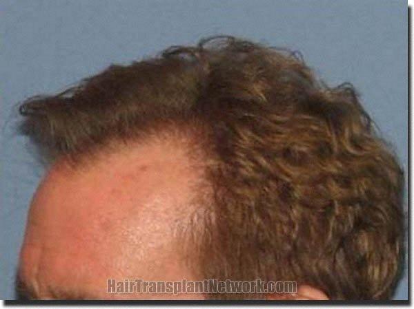 Hair restoration procedure results