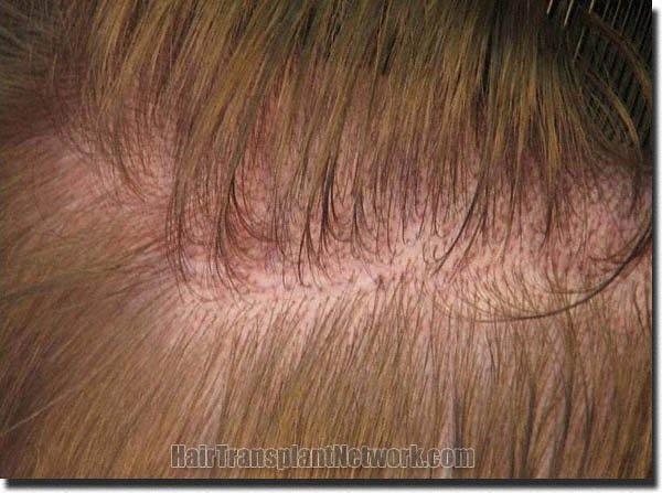 Hair restoration procedure results