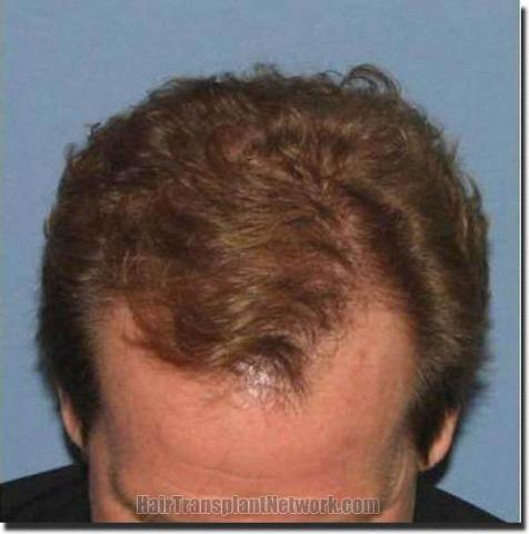 Hair restoration procedure results