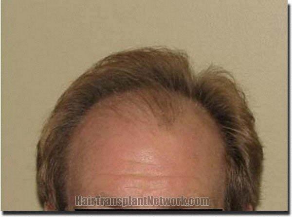 Hair restoration procedure results