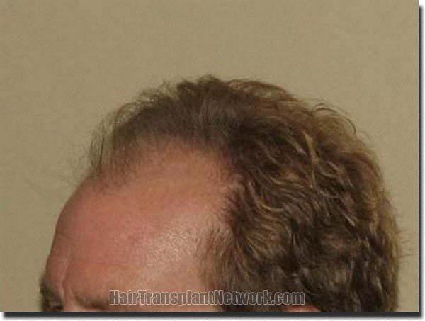 Hair restoration procedure results