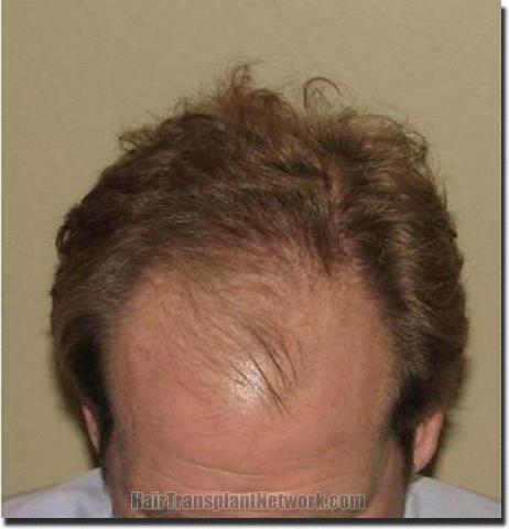 Hair restoration procedure results