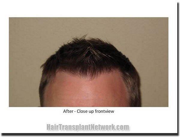 Hair restoration procedure results