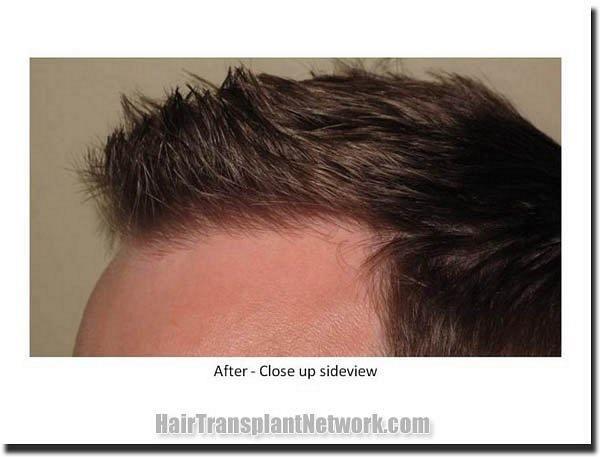 Hair restoration procedure results