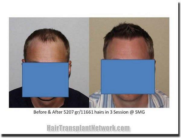 Hair restoration procedure results