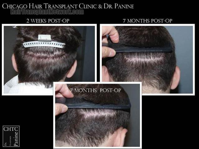 Hair transplantation surgery before and after pictures