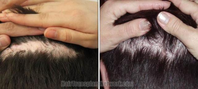 Hair transplantation surgery scar revision