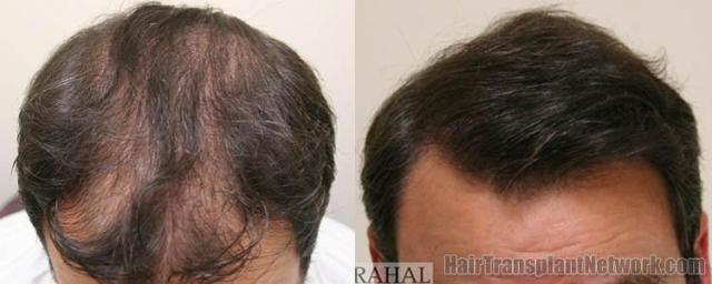 Hair restoration procedure before and after results