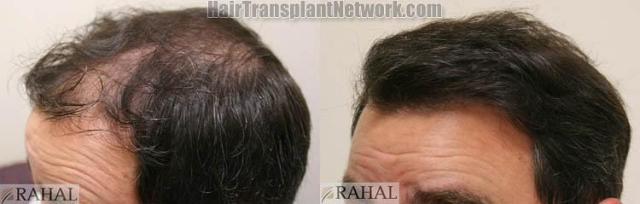 Hair transplantation surgery before and after images