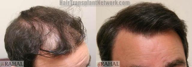 Hair transplantation surgery before and after photos