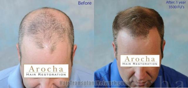 Hair restoration procedure before and after results