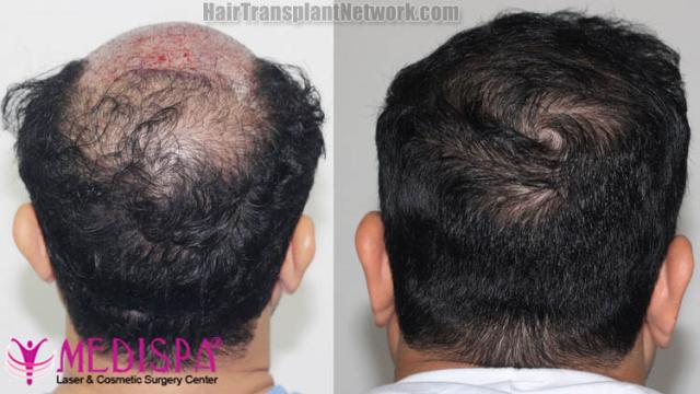 Surgical hair transplantation result photographs