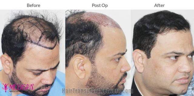 Hair transplantation procedure before and after results