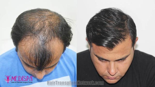 Hair transplantation surgery before and after images