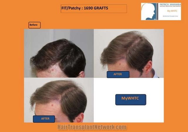 Hair restoration procedure before and after results