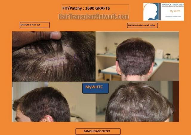 Hair transplantation surgery before and after images