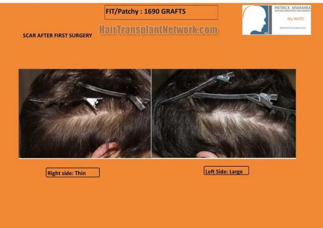 Hair transplantation surgery before and after pictures