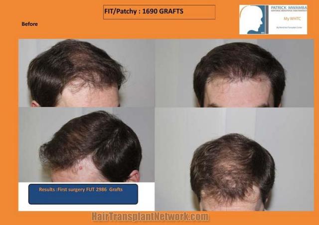 Hair transplantation surgery before and after photos