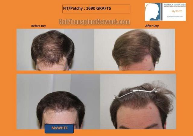 Hair transplantation surgery before and after pictures