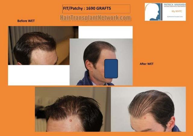 Hair transplantation surgery before and after images