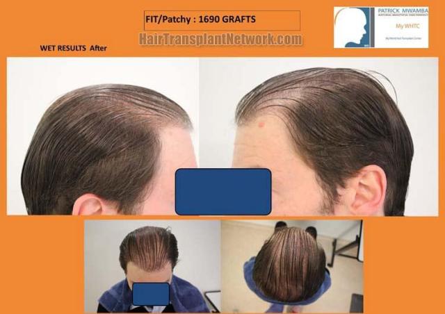 Hair transplantation surgery before and after photos