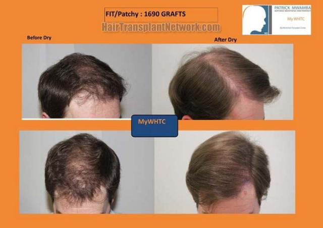 Hair restoration procedure before and after results