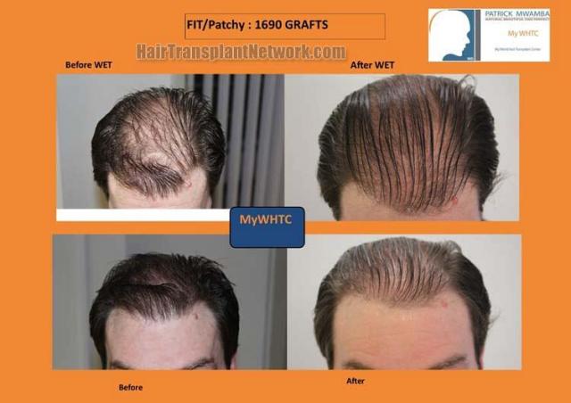 Hair transplantation surgery before and after images