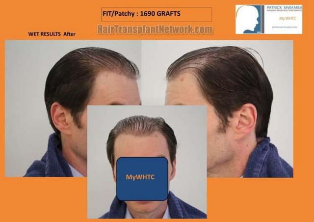 Hair transplantation surgery before and after pictures