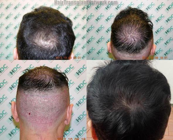  using XXXX grafts viewed from the top, displaying before and after photos.