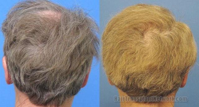 Back of patients head before and after hair transplant