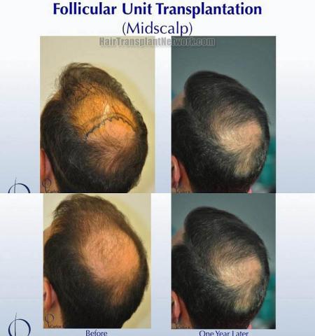 Hair transplantation surgery before and after images