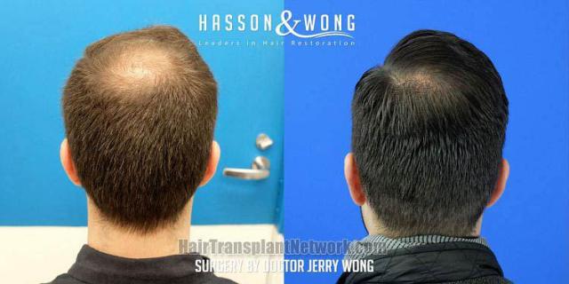 Surgical hair transplantation result photographs