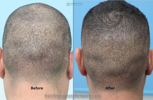 Hair replacement surgery before and after images