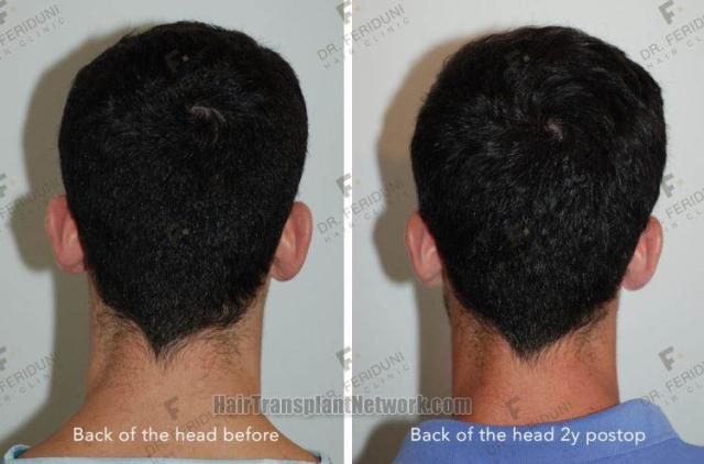 Hair replacement surgery before and after images