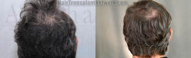 Hair replacement surgery before and after images