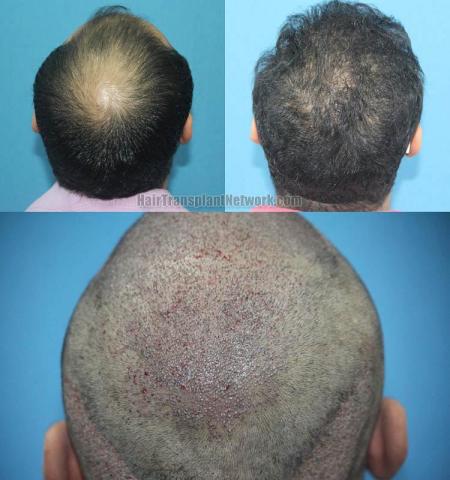 Surgical hair transplantation result photographs