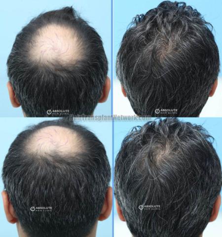 Surgical hair transplantation result photographs