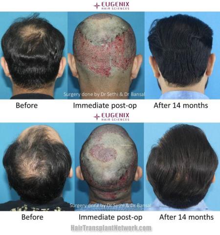 Surgical hair transplantation result photographs