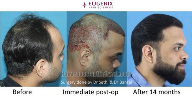 Hair restoration procedure before and after results