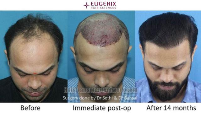 Before and after hair restoration procedure images