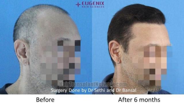 Hair transplantation procedure before and after results