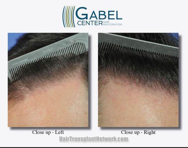 Hair restoration procedure before and after pictures